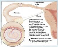 При эктопической беременности оплодотворенное яйцо прикрепляется в неподходящем месте