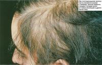 При гипотиреоидизме волосы часто становятся сухими и ломкими
