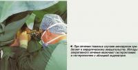 При лечении тяжелых случаев меноррагии прибегают к хирургическому вмешательству