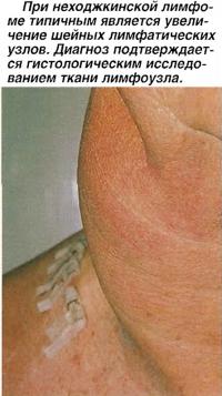 При неходжкинской лимфоме является увеличение шейных лимфатических узлов