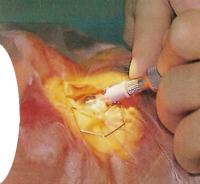 При помощи факонаконечника хирург дробит периферический край ядра хрусталика