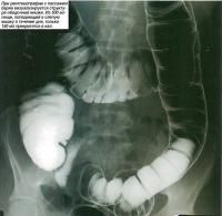 При рентгенографии с пассажем бария визуализируется структура ободочной кишки