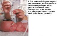 При тяжелой форме инфекции возникает необходимость кормления ребенка через назогастральный зонд