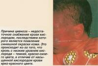 Причина цианоза - недостаточное снабжение крови кислородом