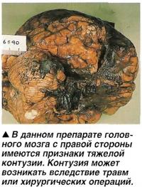 Признаки тяжелой контузии