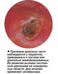 Пролежни довольно часто наблюдаются у пациентов, прикованных к постели