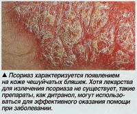 Псориаз характеризуется появлением на коже чешуйчатых бляшек.