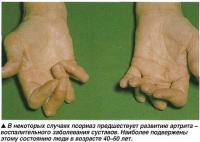 Псориаз предшествует развитию артрита