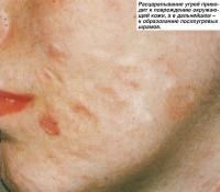 Расцарапывание угрей приводит к повреждению окружающей кожи