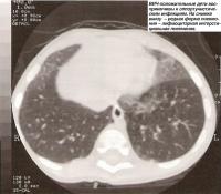 Редкая форма пневмонии - лифмоцитарная интерстициальная пневмония