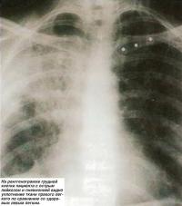 Рентгенограмма грудной клетки пациента с острым лейкозом и пневмонией