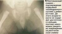 Рентгеновский снимок - подтверждение подвывиха тазобедренного сустава у ребенка 6 мес