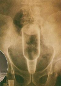 Рентгеновский снимок таза пациента показывает бутылку в прямой кишке
