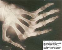 Ревматоидный артрит - аутоиммунное заболевание, поражающее суставы