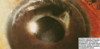 Рубец в верхней части глаза является следствием операции капсулотомии