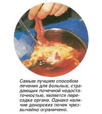 Самым лучшим способом лечения для больных является пересадка почки