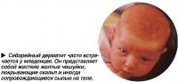 Себорейный дерматит часто встречается у младенцев