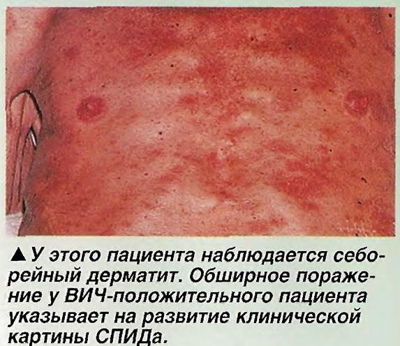 Себорейный дерматит