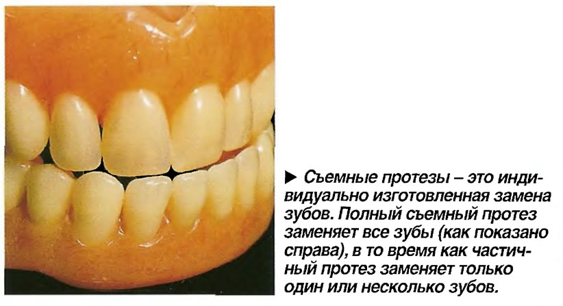 Съемные протезы - это индивидуально изготовленная замена зубов