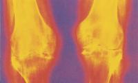 Симметрическая природа инфектартрита на рентгеновском снимке