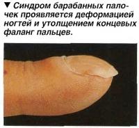 Синдром барабанных палочек