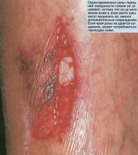 Скальпированные раны передней поверхности голени не зашивают