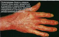 Склеродермия, болезнь соединительной ткани