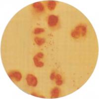 Спинальная жидкость больного с подозрением на менингит под микроскопом