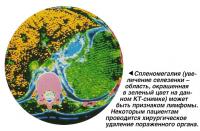 Спленомегалия может быть признаком лимфомы