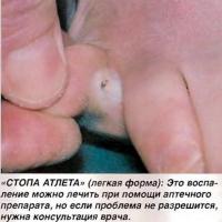 Стопа атлета (легкая форма)