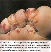 Стопа атлета (тяжелая форма)