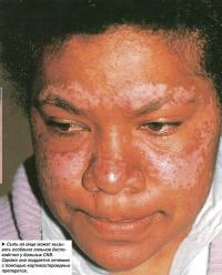 Сыпь на лице может вызывать особенно сильное беспокойство у больных СКВ