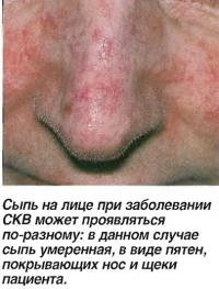 Сыпь на лице при заболевании СКВ может проявляться по-разному