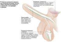 Сжатие клапанного механизма в мошонке вызывает поступление специальной жидкости в имплантат