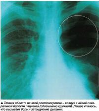 Темная область на этой рентгенограмме - воздух в левой плевральной полости пациента