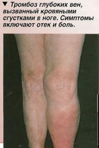 Тромбоз глубоких вен