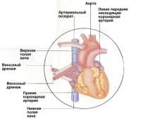 Трубка артериального возврата вставляется в аорту