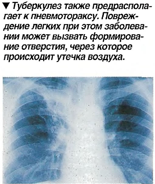 Туберкулез также предрасполагает к пневмотораксу