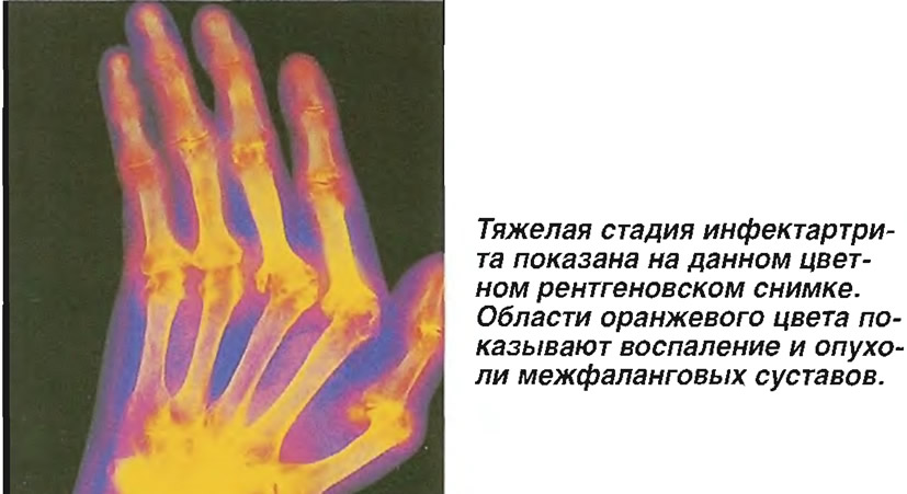 Тяжелая стадия инфектартрита на цветном рентгеновском снимке