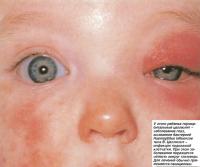 У этого ребенка периорбитальный целлюлит - заболевание глаз