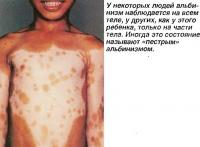 У некоторых людей альбинизм наблюдается только на части тела