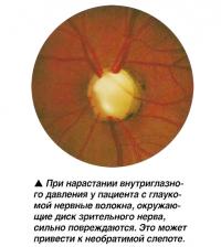 У пациента с глаукомой нервные волокна, окружающие диск зрительного нерва, сильно повреждаются