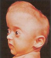 У ребенка с оксицефалией видна скошенная макушка и недоразвитый свод