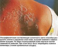 Ультрафиолетовая составляющая света способна разрушить клетки в наружном слое кожи