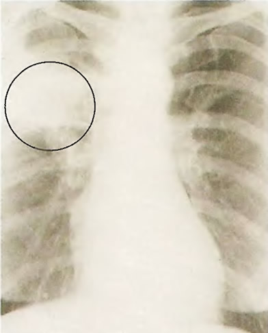 Уплотнение на рентгеновском снимке