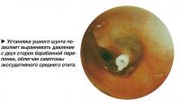 Установка ушного шунта выравнивает давление с двух сторон барабанной перепонки