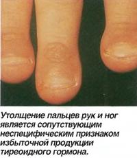 Утолщение пальцев рук и ног