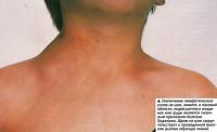 Увеличение лимфатических узлов на шее, животе, в паховой области...