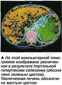 Увеличенная в результате портальной гипертензии селезенка