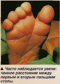 Увеличенное расстояние между первым и вторым пальцами стопы